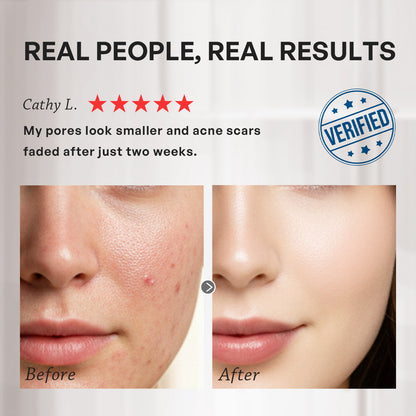 【TRUU】45 Pores Refining Blemish Treatment Essence