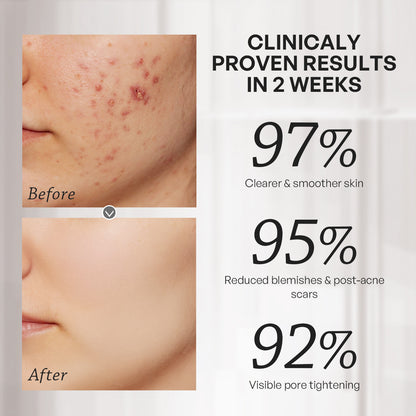 【TRUU】45 Pores Refining Blemish Treatment Essence