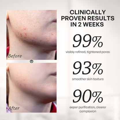 【TRUU】2% Salicylic Acid Pore Minimising Bubble Mask